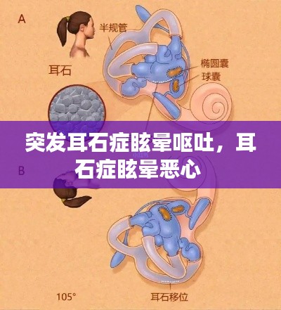 突发耳石症眩晕呕吐,耳石症眩晕恶心